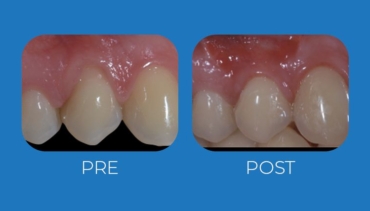 Chirurgia plastica parodontale