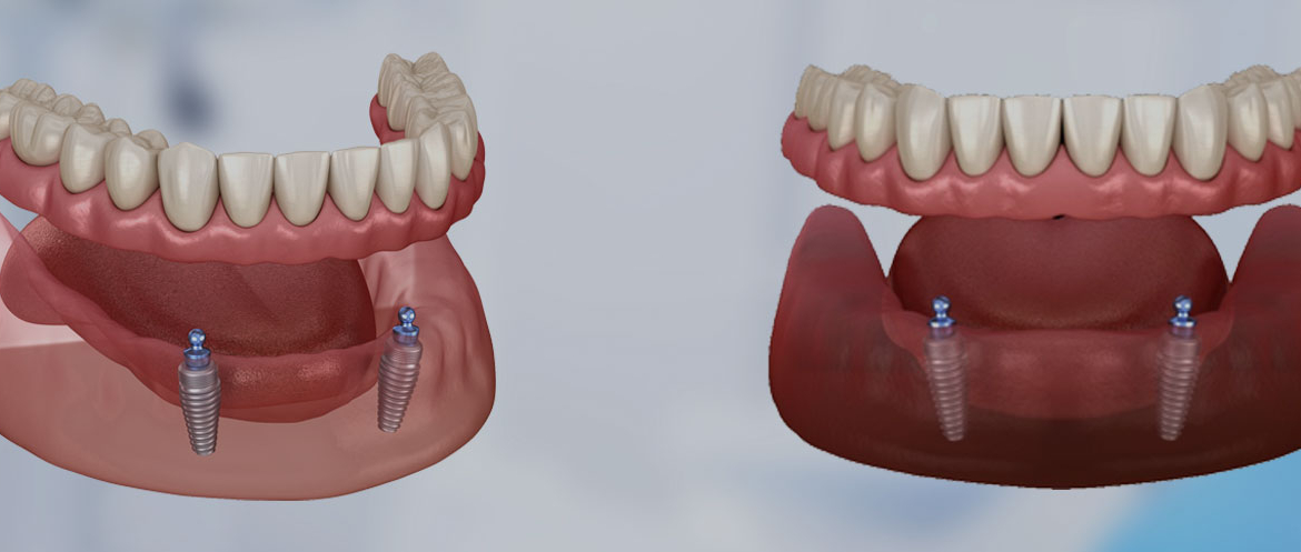 Protesi dentale mobile