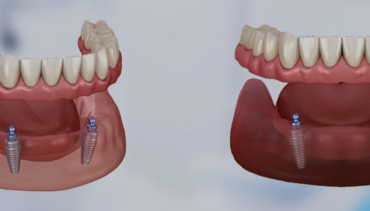 Protesi dentale mobile